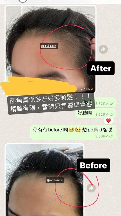 客人WhatsApp反饋:額角真係多左好多頭髮